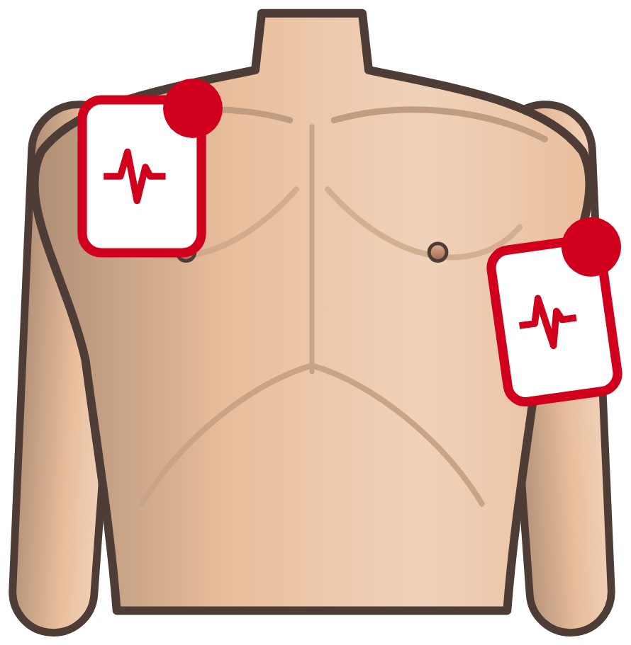 Posizione delle piastre del defibrillatore sul torace